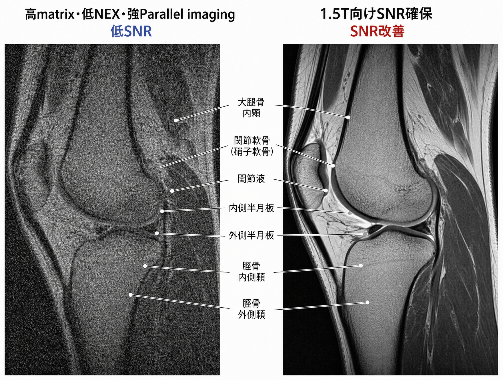 膝MRIの低SNRとSNR改善の比較