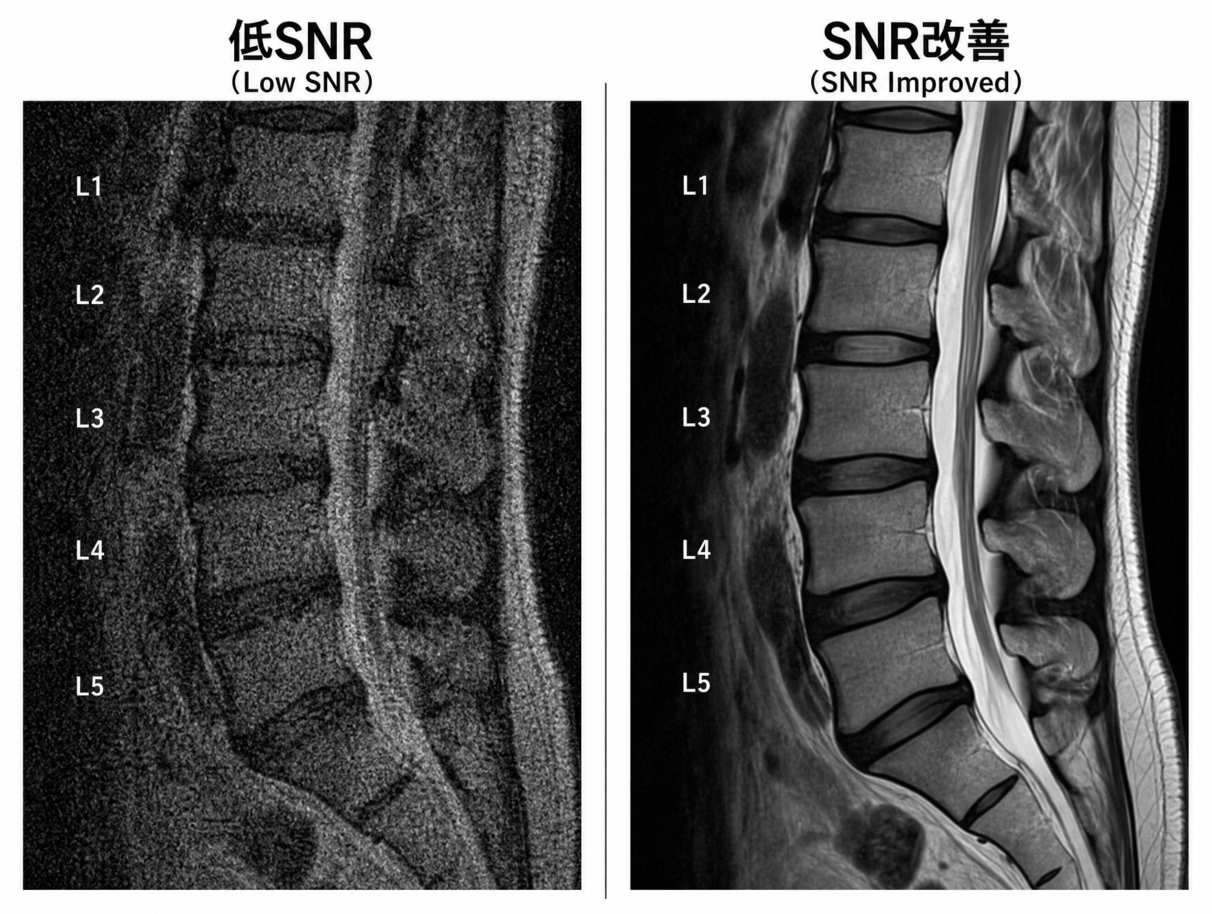 腰椎MRIの低SNRとSNR改善の比較