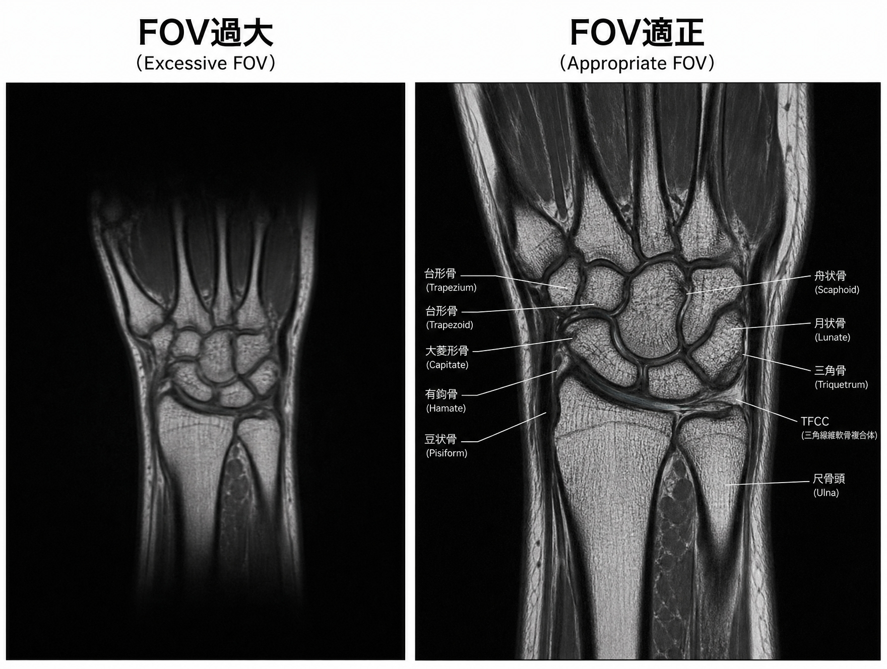 手関節MRIのFOV過大とFOV適正の比較