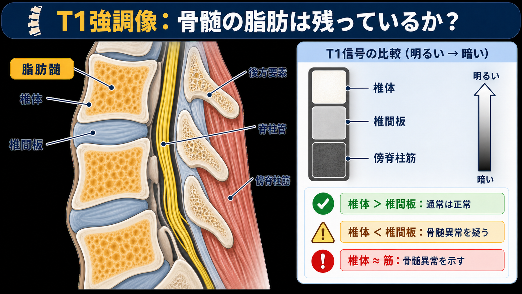 腰椎MRIで「META」を疑うとき ── 転移性圧迫骨折と良性骨折の鑑別