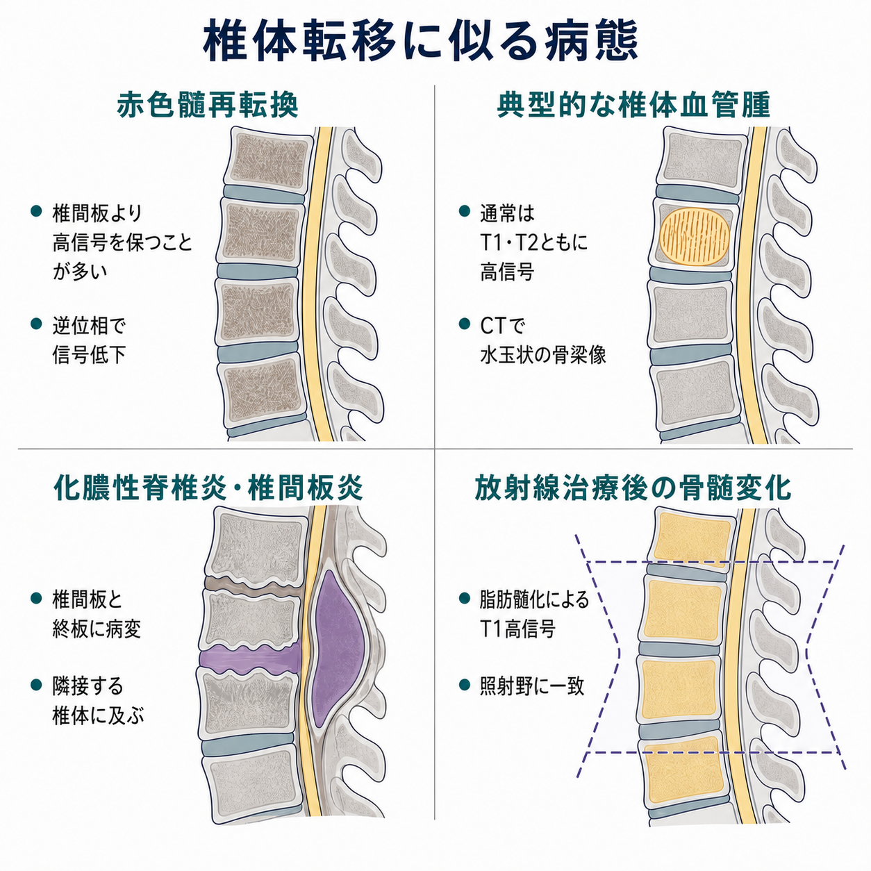 椎体転移に似る4病態の模式図